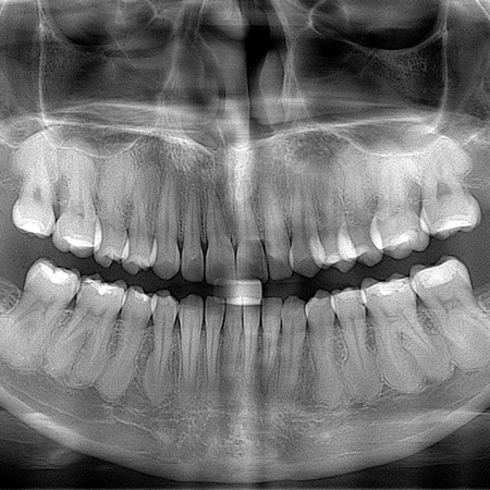 Hipercementose: os dentes podem ou não ser movimentados?