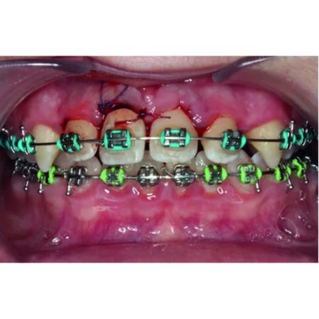 Management of ankylosed teeth using the decoronation technique: integrative literature review and case report