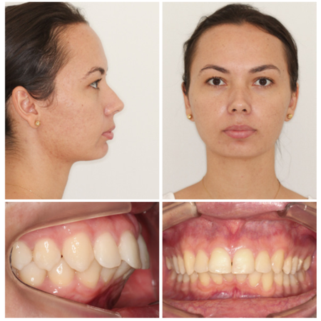 Orthodontic treatment with aligners in a patient with severe periodontal impairment caused by a hygienic 3x3 bar retainer: case report
