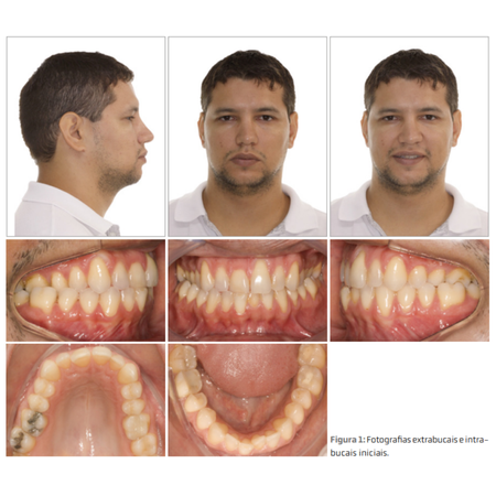 Tratamiento de la mordida  cruzada posterior en un adulto con  compromiso periodontal, mediante  una técnica sencilla sin cirugía