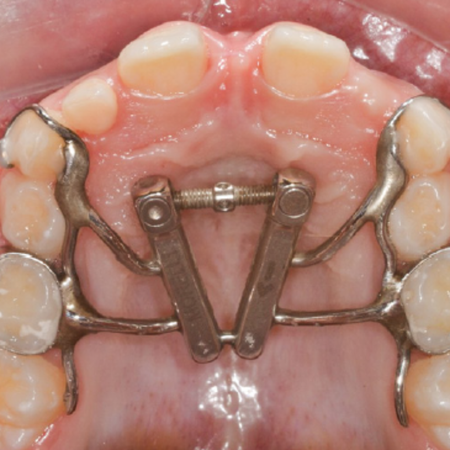 Midpalatal suture split after differential and fan-type expansion: a secondary analysis from a randomized clinical trial