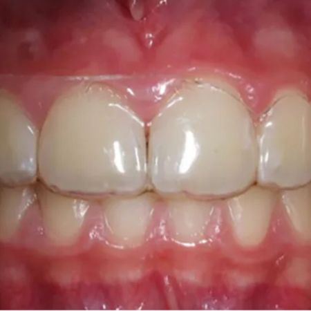 Edge level of aligners and periodontal health: a clinical perspective study in young patients