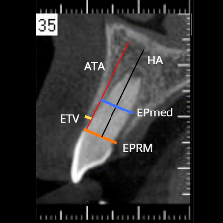 Growth of buccal bone plate after dental autotransplantation