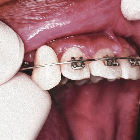 Adaptação de dente provisório no aparelho fixo