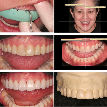 A novel step for the fabrication of resin provisionals for improved gingival health and esthetic predictability of ceramic laminates: a case report