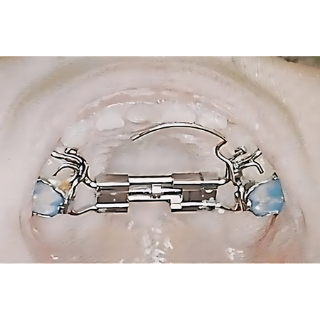 Rapid maxillary expansion and its impact on sleep apnea in children aged 5 to 8 years: a retrospective study