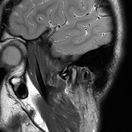Ultrasound use for TMJ arthrocentesis: case report