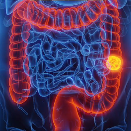 Associação entre periodontite e câncer colorretal: uma revisão integrativa de literatura