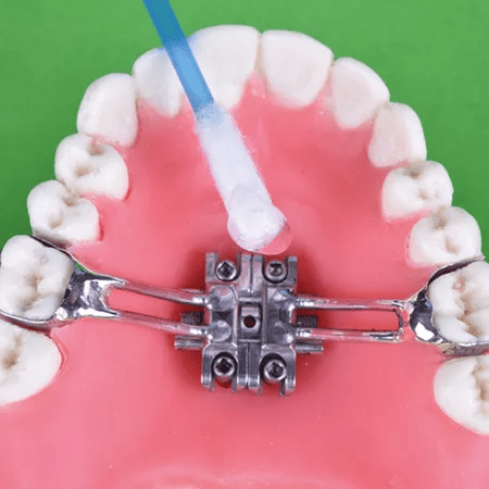 Directrices de higiene para expansores maxilares dentosoportados, dentomuco-soportados y dentooseo-soportados