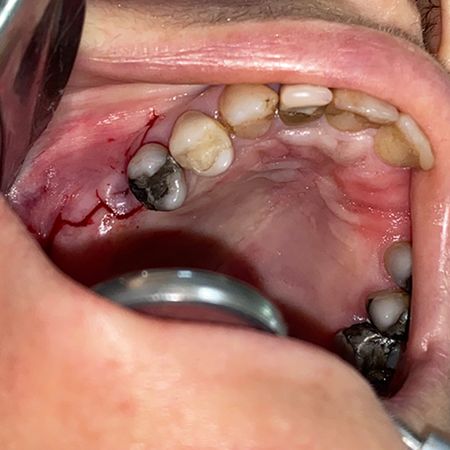 Tratamento de fístula oroantral com corpo adiposo bucal: Relato de Caso