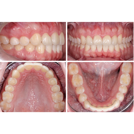 Table Tops: uma alternativa inovadora para manejo da mordida profunda