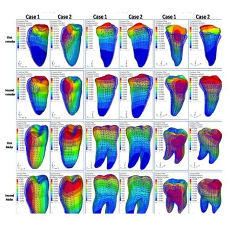 Comparative evaluation of displacement and stress distribution pattern during mandibular arch distalization with extra and inter-radicular mini-implants: a three-dimensional finite element study