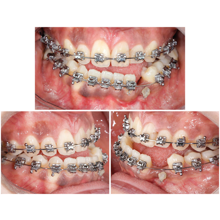 Clinical subtleties for orthodontists to be aware of