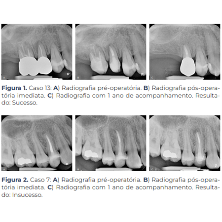 The accuracy in predicting the outcome of non-surgical endodontic retreatment by different dental practitioners: a preliminary study
