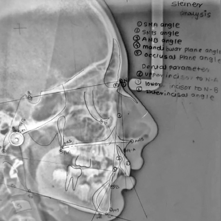 Pediatric validation of an AI-assisted smartphone application (WebCeph) for cephalometric analysis: reliability, reproducibility and time-efficiency assessment