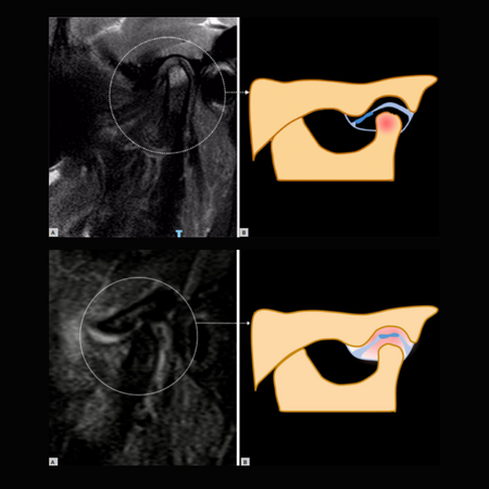 Unveiling MRI-based structural phenotypes in temporomandibular joint osteoarthritis: implications for clinical practice and research