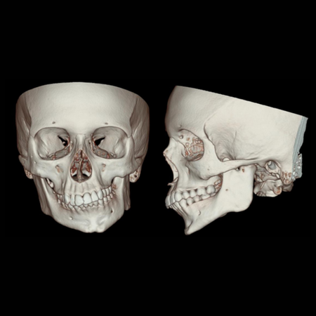 Etiologia e tratamento da anquilose da articulação temporomandibular: um estudo retrospectivo