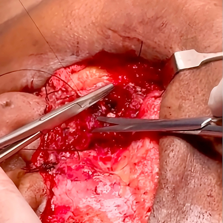 Neurorrhaphy from masseteric nerve to facial nerve: case report