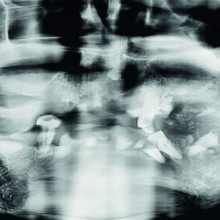 Exeresis of peripheral ossifying fibroma gigantiform: case report