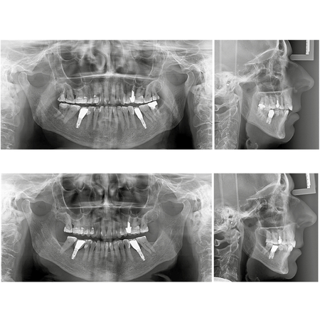 Orthodontic-rehabilitative treatment of Class II malocclusion and anterior open bite in a patient with implants in the lower first molar region: case report treated with aligners