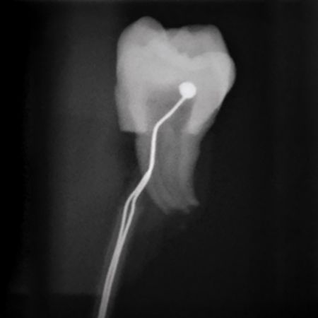 Elevação na temperatura da câmara pulpar durante a colagem de braquetes com fotoativação usando ou não primer, em dentes hígidos versus dentes restaurados