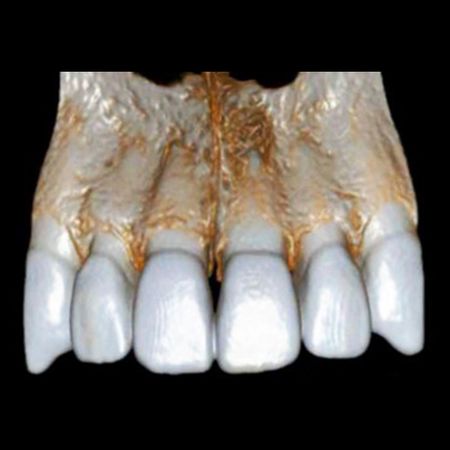 Necrose pulpar asséptica como causa de lesão periapical crônica em dente com subluxação dentária