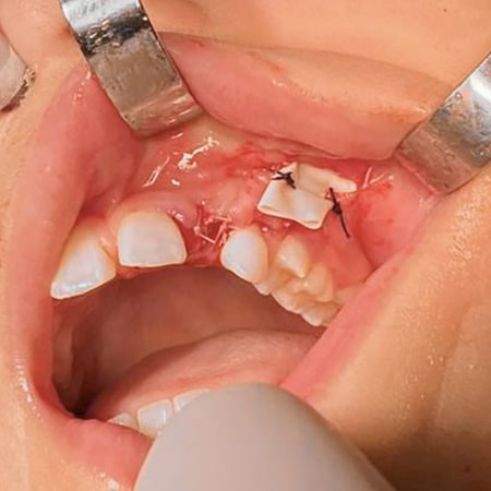 Dens in dente e celulite facial: relato de caso