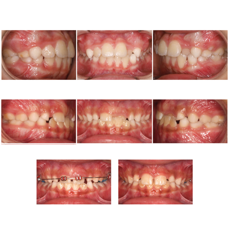 Técnicas 2x4 e 2x2 na correção da mordida cruzada anterior dentária