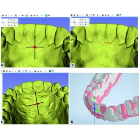 A new way of analyzing tooth movement using universal coordinate system geometry single point superposition in a 3D model
