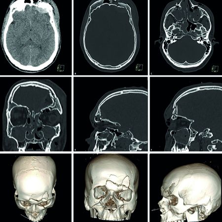 Treatment of complex fracture of the middle and upper thirds of the face: a case report