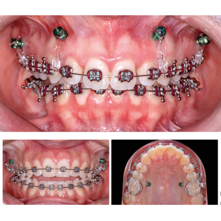 Challenges of treating patients with vertical discrepancies: clinical approaches using mini-implants