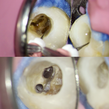 Conceito TomoMicroSonic: Uma Nova Abordagem Integrada e Avançada para a Endodontia Contemporânea
