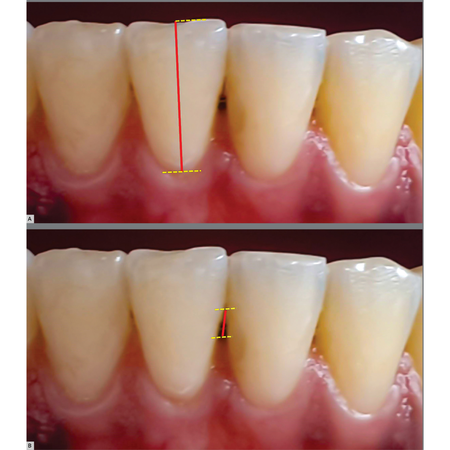 Gingival changes after removal of fixed orthodontic appliances: a prospective cohort clinical study