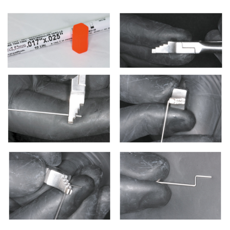 Simple cantilever, with 0.017“ x 0.025” TMA wire, for verticalizing mesially angled mandibular second molars