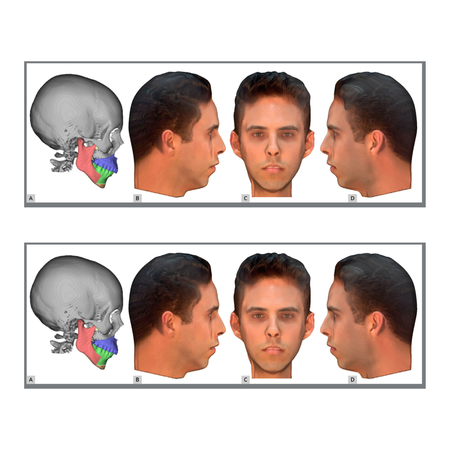 Three-dimensional evaluation of facial attractiveness of skeletal Class II patient: comparative analysis after orthodontic and surgical simulations