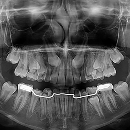 Maxillary canines retained in the palate: tutorial for clinical cases