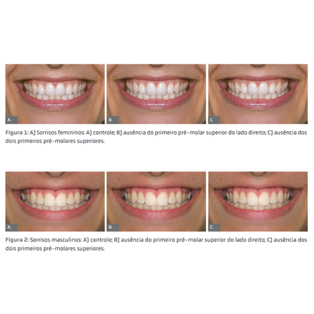 ¿La ausencia unilateral o bilateral de  los primeros premolares influye en la  percepción de la estética de la sonrisa?