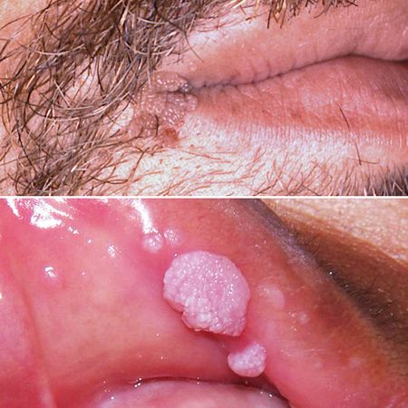 HPV-induced Oral lesions