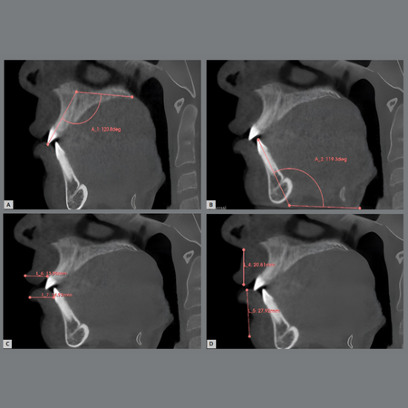 Incisors inclination in relation to lip parameters: a CBCT study