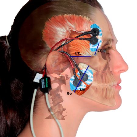 Response of masticatory muscles to treatment with orthodontic aligners: a preliminary prospective longitudinal study