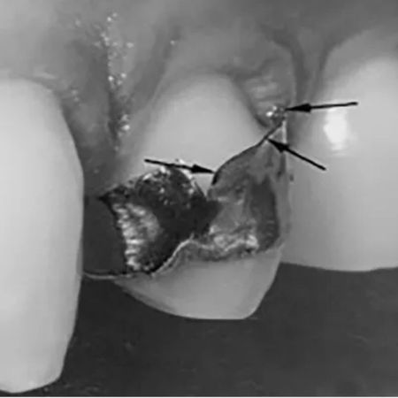 Effect of an aqueous 4% titanium tetrafluoride solution on preventing caries in orthodontic patients: a controlled clinical trial