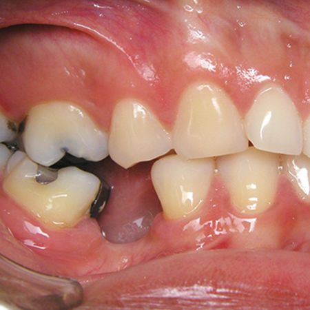 Mecânica ortodôntica e estética do sorriso: uma poderosa combinação em Ortodontia