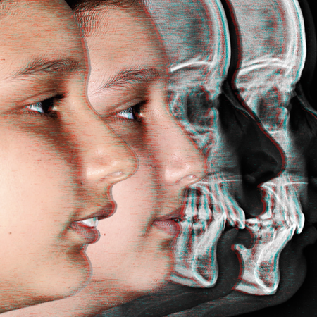 Hybrid treatment of skeletal Class II malocclusion with functional orthopaedics and Invisalign in an 11-year-old child