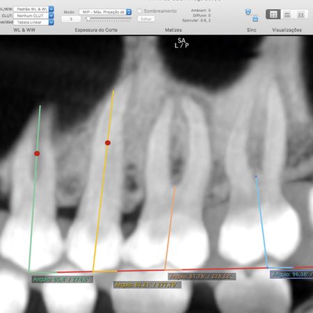 Avaliação da angulação mesiodistal e da posição vertical do segundo molar superior na oclusão normal