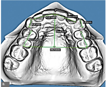 Avaliação das mudanças tridimensionais após trata- mento ortodôntico em casos de baixa complexidade, usando braquetes autoligáveis, braquetes convencio- nais ou sistema fixo sem braquetes