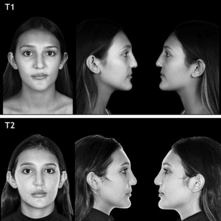 Evaluation of facial pleasantness in patients with complete and unilateral cleft lip and palate rehabilitated and submitted to orofacial harmonization
