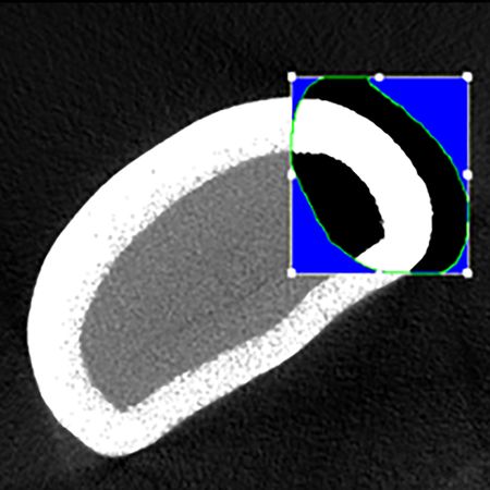 Evaluation of enamel thickness of mandibular incisors