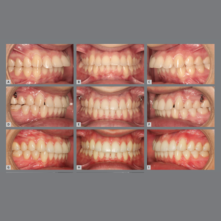 Orthodontic retainers: are they all the same?