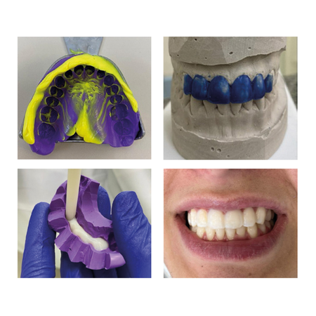 Conservative smile rehabilitation  using direct restorations after orthodontic  treatment: report of a case with dental dimensional  discrepancy