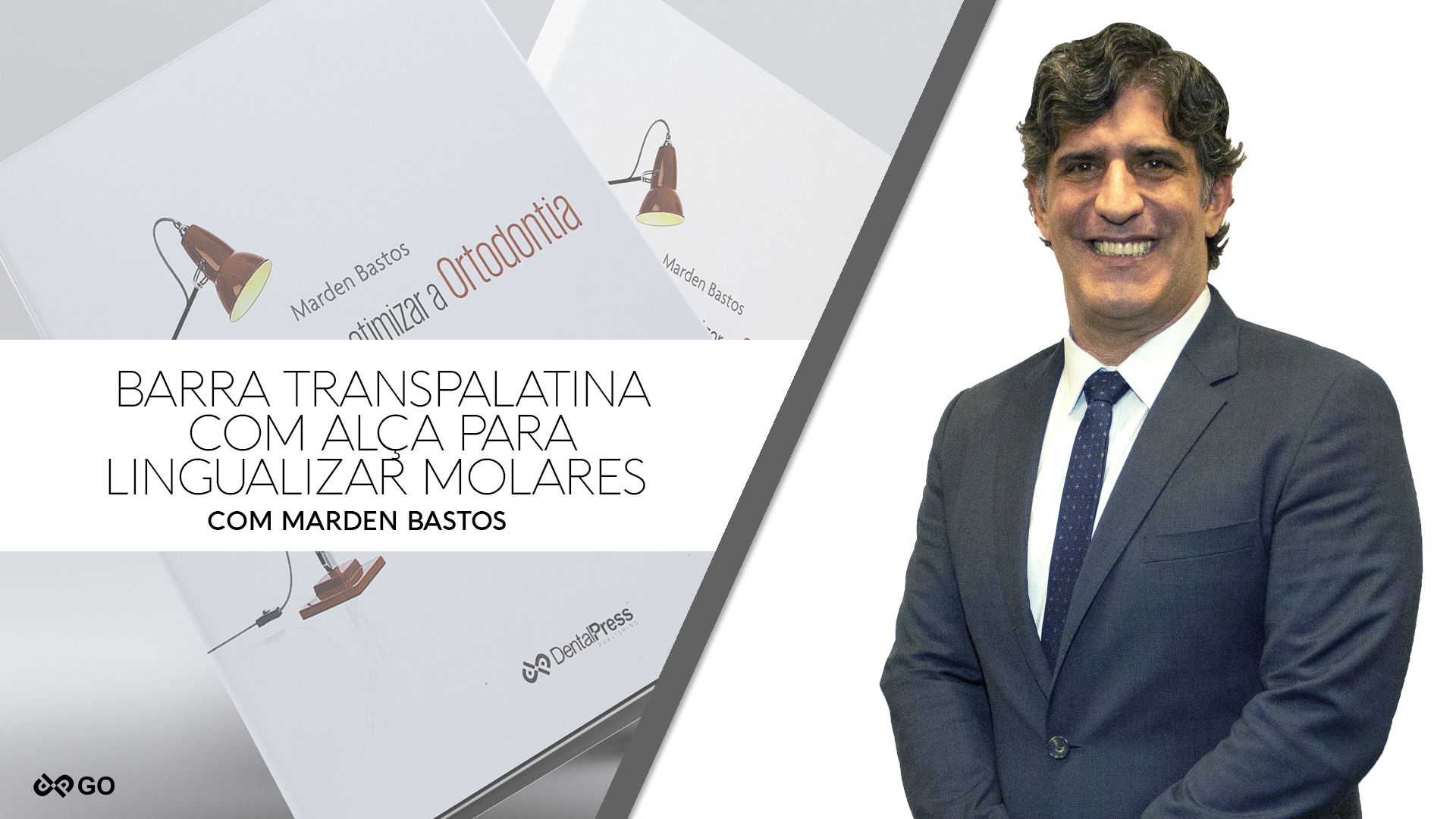 Barra Transpalatina com Alça para Lingualizar Molares - Dr. Marden Bastos